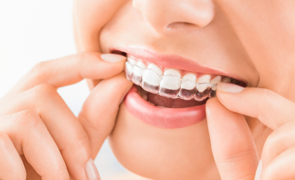 歯科医院のホワイトニングの特徴